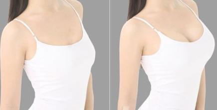 上海华美李健假体隆胸案例图 上海华美整形医院李健假体隆胸多少钱?案例图