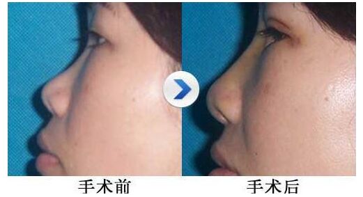 北京自体脂肪填充隆鼻案例图