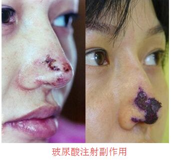 玻尿酸注射鼻尖导致血栓或者组织坏死 玻尿酸注射鼻尖导致血栓或者组织坏死