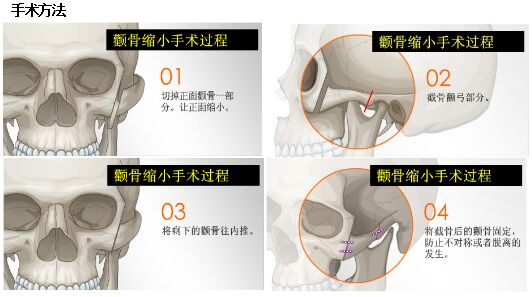 磨颧骨整形手术方法 磨颧骨整形手术方法