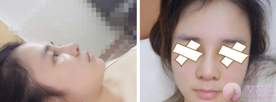 上海喜美徐文龙隆鼻整形怎么样?有没有案例?