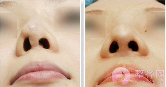 武汉五洲美莱刘俊隆鼻怎么样?多少钱?