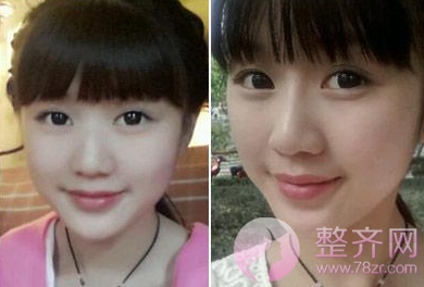 四川华美紫馨艾玉峰隆鼻怎么样?