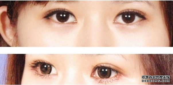 双眼皮怎么做果好? 多少钱?
