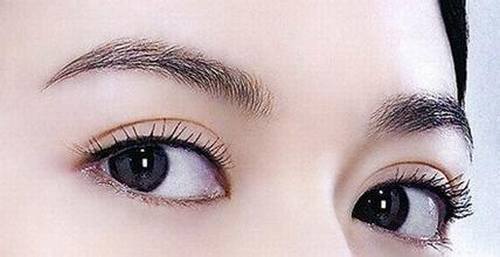 双眼皮手术有几种?那种好？多少钱？