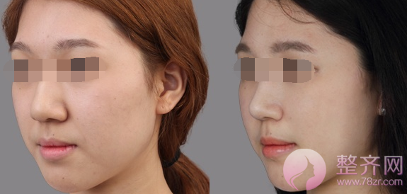 成都西蝉萧庆昌隆鼻多少钱?有没有案例?