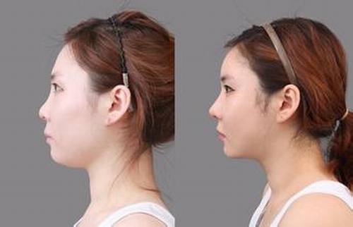 自体脂肪填充好不好？有什么缺点？多少钱？