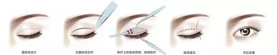 成都米兰柏羽高亮割双眼皮多少钱?案例图?