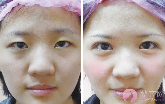 成都米兰柏羽高亮割双眼皮多少钱?案例图?