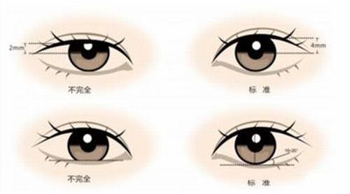 双眼皮为什么会失败？失败后怎么办？