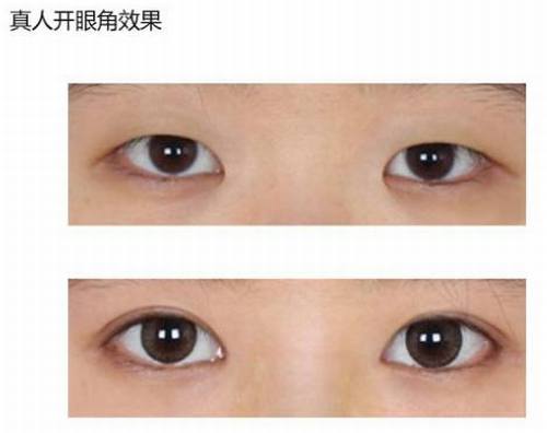 眼角手术怎么样？多少钱？