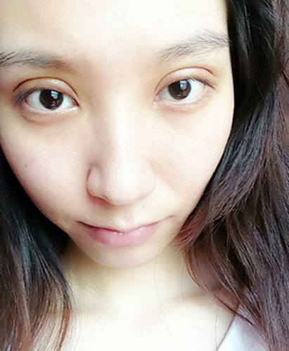 双眼皮+去脂肪的案例分享