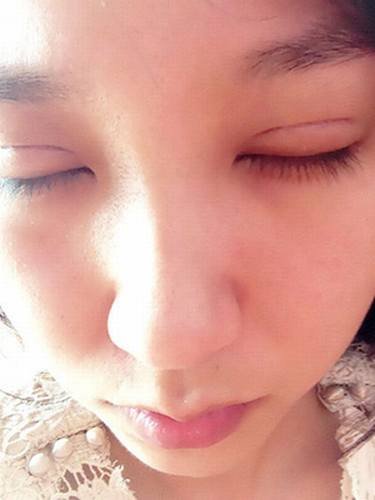 双眼皮+去脂肪的案例分享