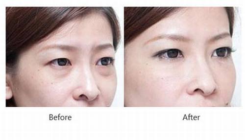 激光祛眼袋果能维持多久?多少钱?