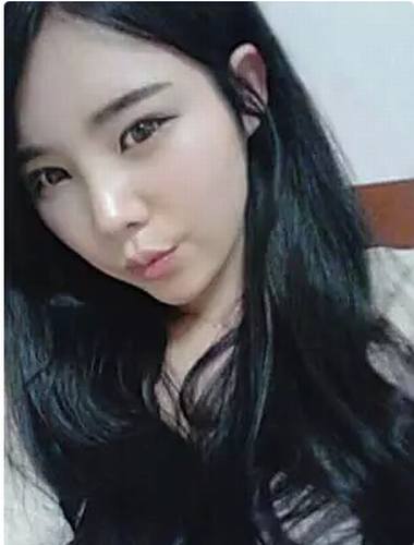 开扇形双眼皮案例