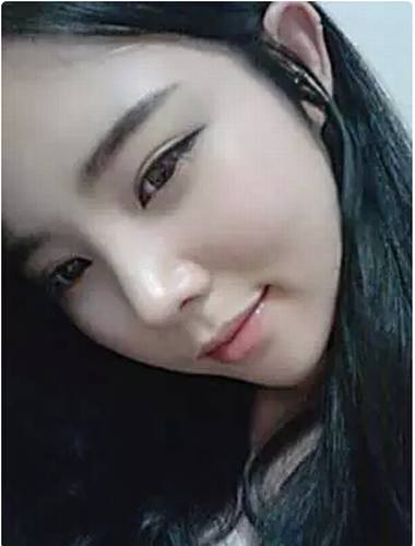 开扇形双眼皮案例