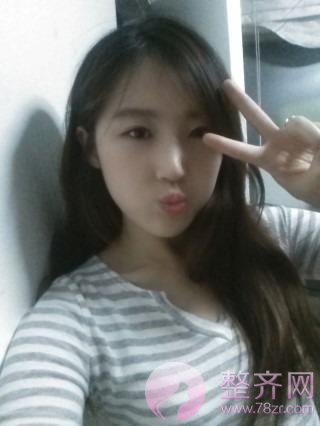 双眼皮和鼻部手术案例分享