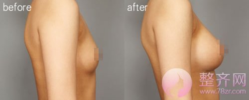 假体隆胸,胸部的二次领先