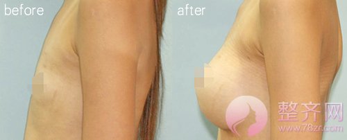 假体隆胸,胸部的二次领先