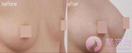 假体隆胸,胸部的二次领先