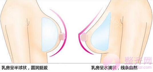 假体隆胸,胸部的二次领先