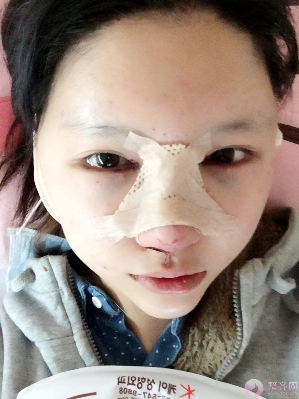 鼻中隔软骨隆鼻,脂肪填充术后8个月