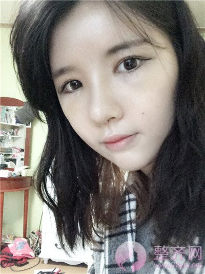 鼻中隔软骨隆鼻,脂肪填充术后8个月