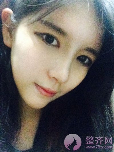 鼻中隔软骨隆鼻,脂肪填充术后8个月