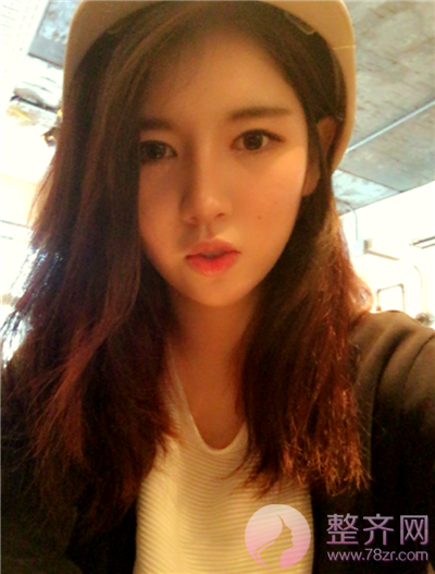 鼻中隔软骨隆鼻,脂肪填充术后8个月