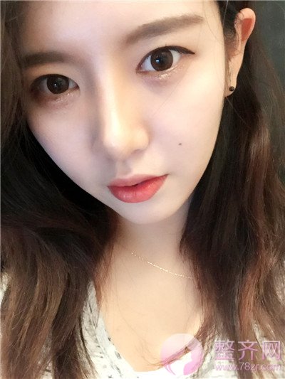 鼻中隔软骨隆鼻,脂肪填充术后8个月