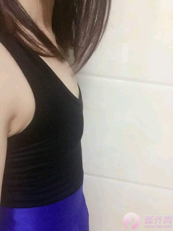 假体隆胸案例分享