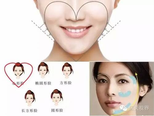 自体脂肪填充面部是怎么样的？如何避免失败？