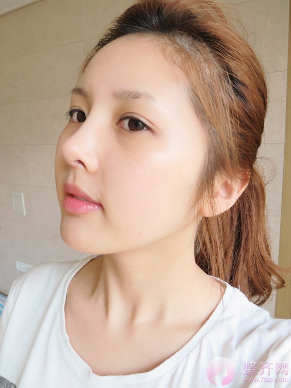 自体脂肪填充额头案例