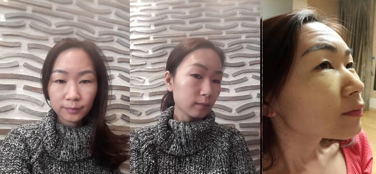 下血本了,把鼻子眼睛脂肪填充都做了