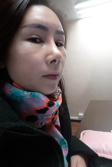 下血本了,把鼻子眼睛脂肪填充都做了