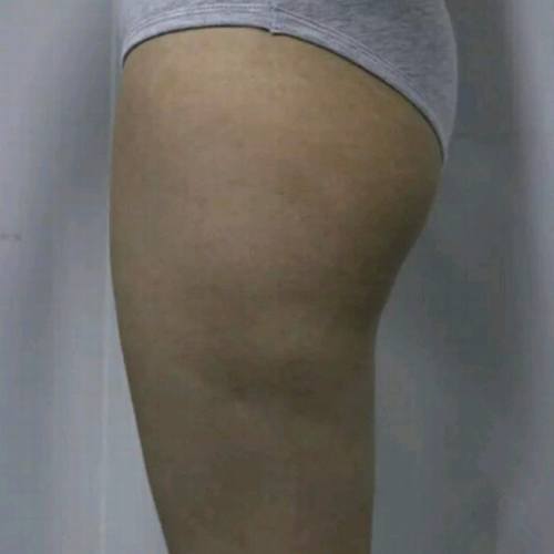 上海百达丽顾清吸脂怎么样？多少钱？案例？