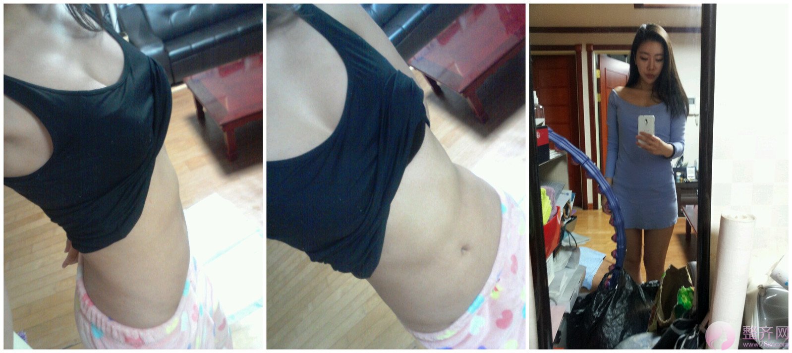 自体脂肪隆胸,环吸(手臂、腹部)术后1年的后