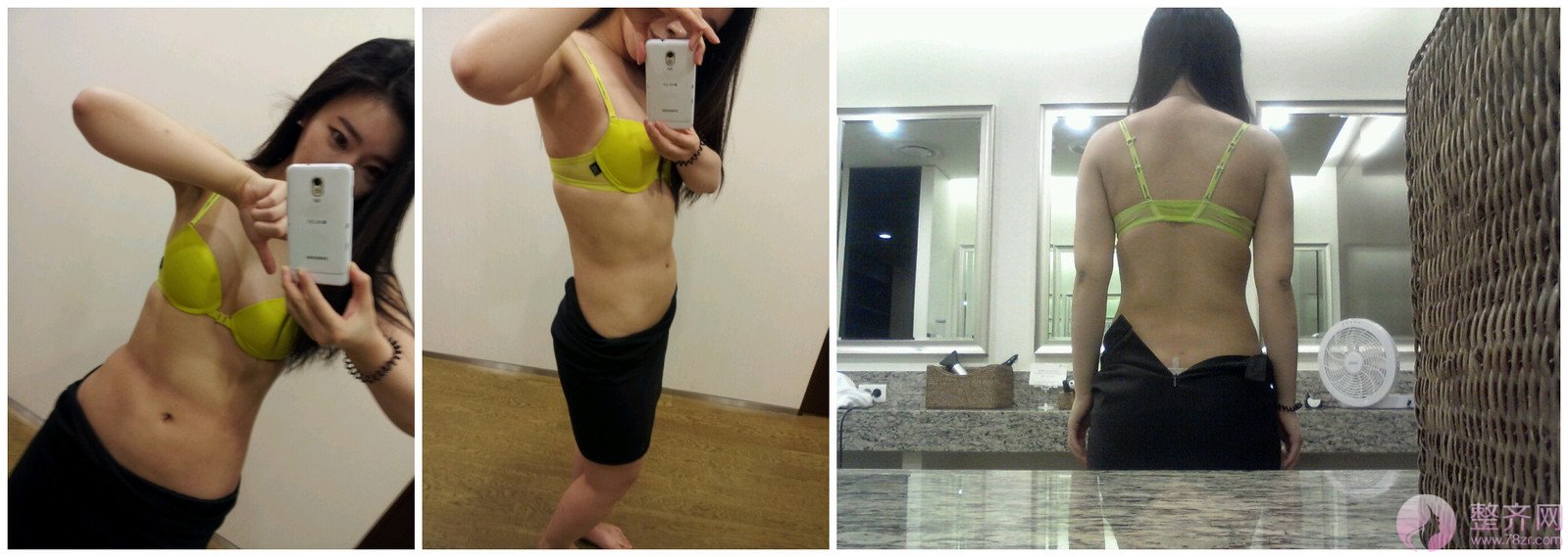 自体脂肪隆胸,环吸(手臂、腹部)术后1年的后