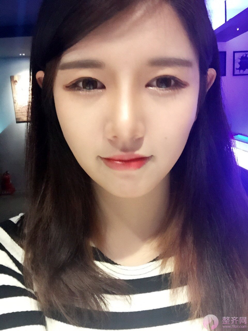 定制鼻整形，脂肪填充术后8个月后记