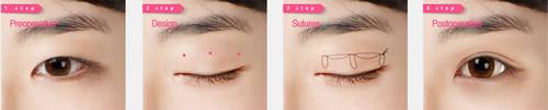 埋线双眼皮怎么样?多少钱?