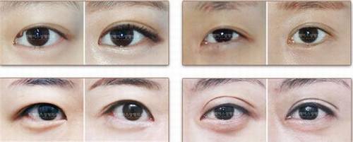 双眼皮失败怎么修复？多少钱？