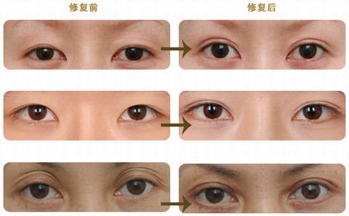 双眼皮失败怎么修复？多少钱？