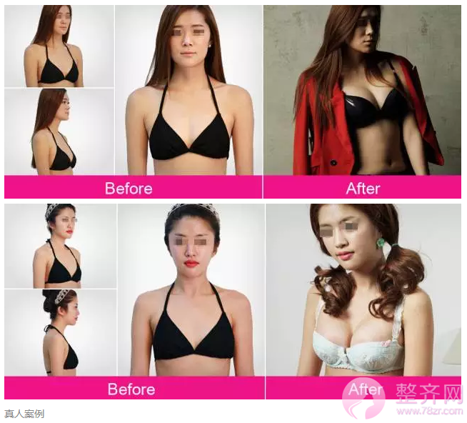 假体隆胸会影响哺乳吗?