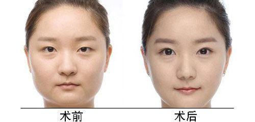 北京金凤凰丁砚江面部吸脂怎么样？多少钱？