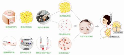 自体脂肪丰太阳穴果好吗？多少钱？