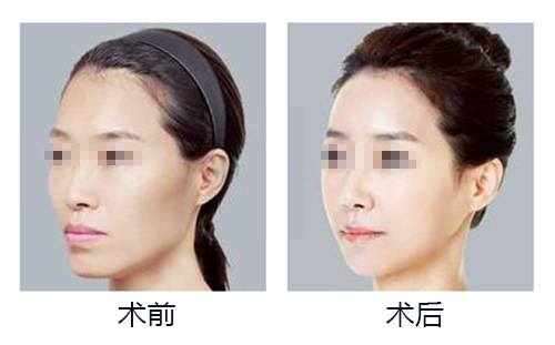 自体脂肪丰太阳穴果好吗？多少钱？