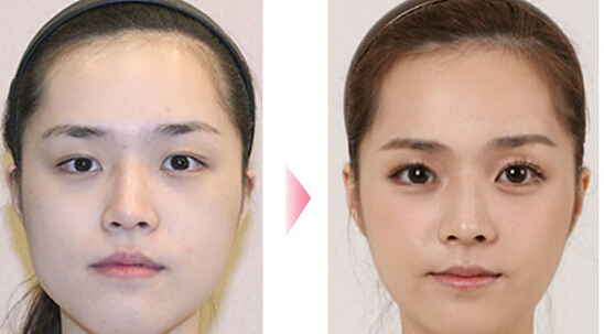 自体脂肪填充卧蚕怎么样？多少钱？