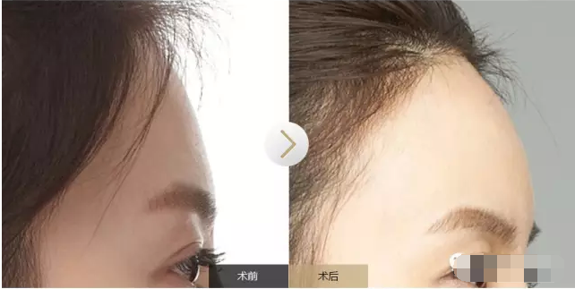 自体脂肪填充额头