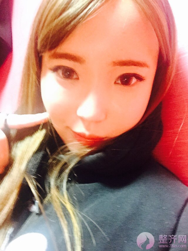 自体脂肪填充全脸4个月