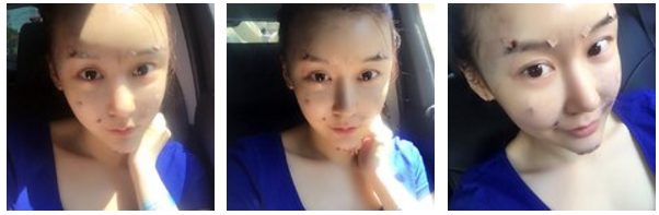 自体脂肪垫下巴